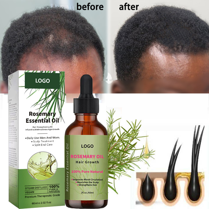 ¿Se utiliza el aceite esencial de romero para hacer crecer el cabello y reducir su caída? El efecto es mejor que.....